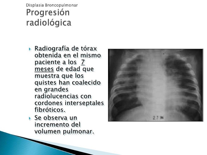 broncodisplasia pulmonar en nios